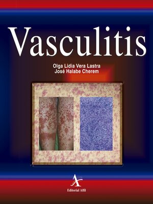 cover image of Vasculitis